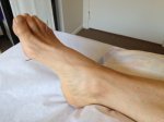Needles in foot