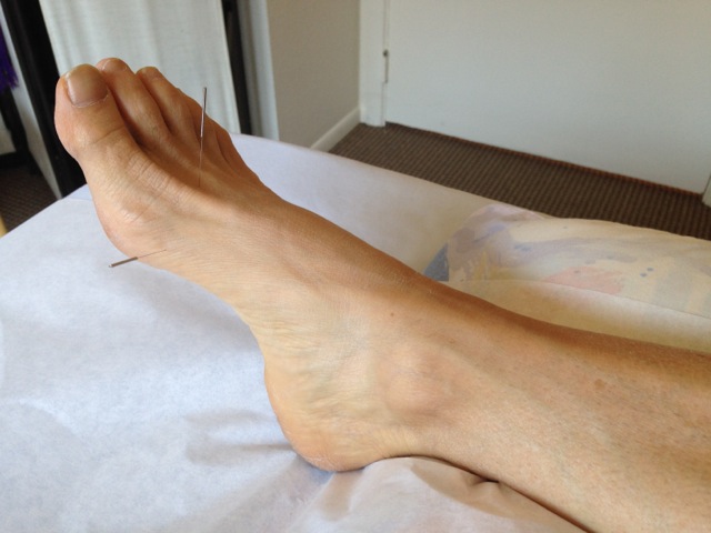 Needles in foot